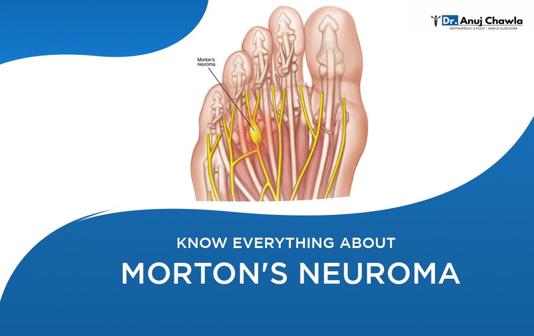 Know everything about Morton's Neuroma