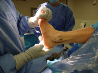 Ankle Ligament Repair- the ultimate option to cure severe ankle problems